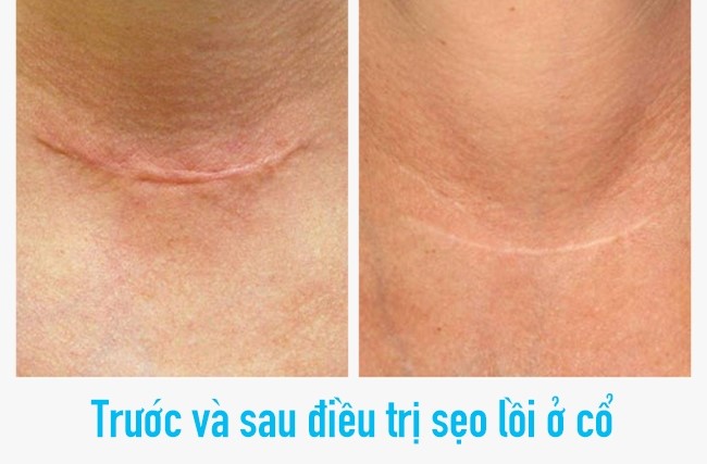 Điều trị tan sẹo lồi