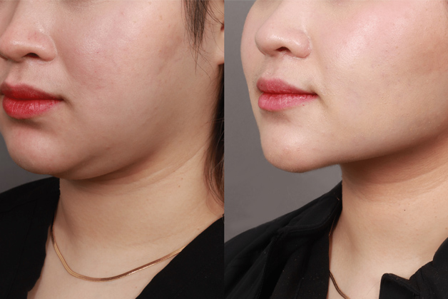 tiêm tan mỡ nọng cằm