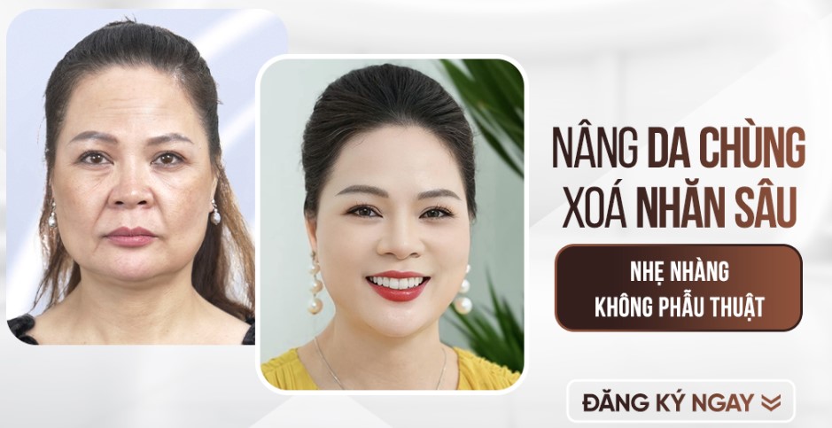 Dịch vụ xóa nếp nhăn